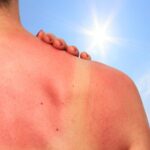 Sunburn and Tanning-Facts and Skincare Tips