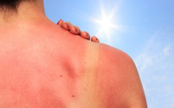 Sunburn and Tanning-Facts and Skincare Tips