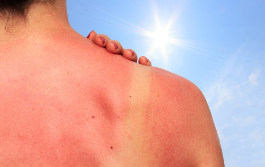 Sunburn and Tanning-Facts and Skincare Tips